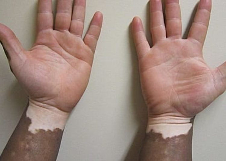 Vitiligo associated with lower incidence of skin cancers