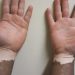 Vitiligo associated with lower incidence of skin cancers