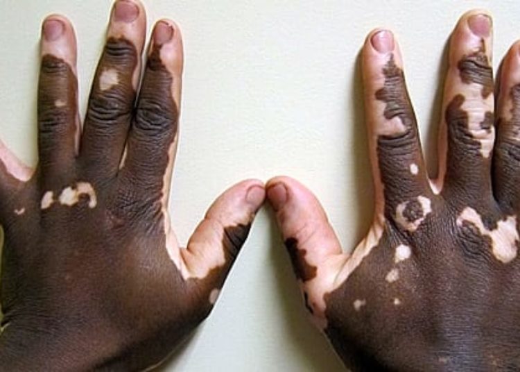 Afamelanotide plus UV-B phototherapy effective for vitiligo