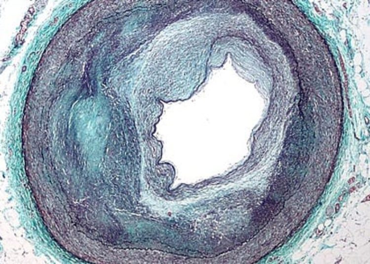 Ivabradine ineffective in stable coronary artery disease [SIGNIFY trial]