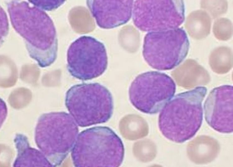 Severe subtype of acute lymphoblastic leukemia susceptible to FDA-approved kinase inhibitors
