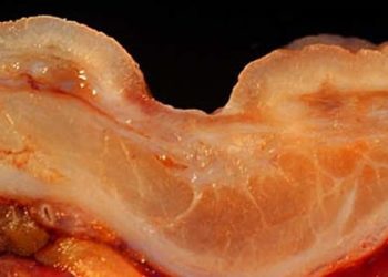 Proton pump inhibitor boluses as effective as infusions in ulcer bleeds