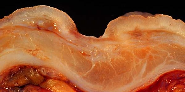 Benign_gastric_ulcer_3