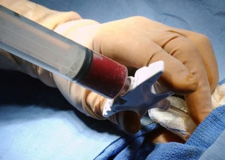 Gender mismatch linked with autoimmune disease in chronic graft-vs-host disease