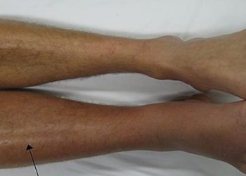 Most anticoagulants for venous thromboembolism similarly effective