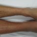 Most anticoagulants for venous thromboembolism similarly effective