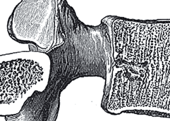 Spinal manipulation therapy effective for back-related leg pain