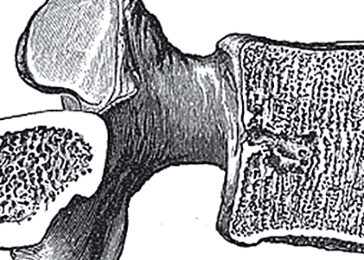 Spinal manipulation therapy effective for back-related leg pain