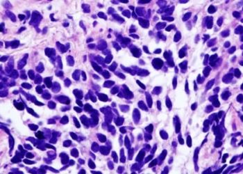 Thoracic radiotherapy improves survival in small-cell lung cancer patients