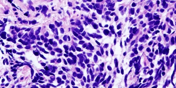 SCLC lung cancer