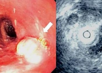 Salvage surgery may improve survival in local recurrence of esophageal cancer