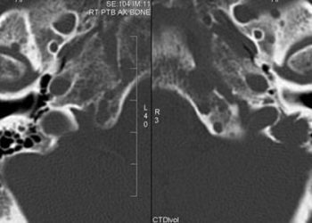 Chemotherapy and stem-cell transplant for multiple myeloma remain superior