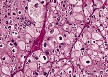 Pediatric renal and thyroid cancer rates increase