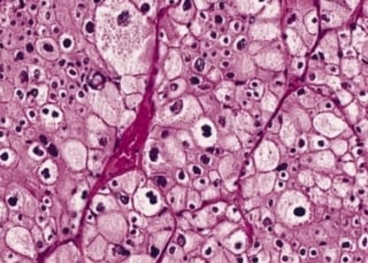 Pediatric renal and thyroid cancer rates increase