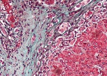 Polyethylene glycol superior to lactulose for hepatic encephalopathy [HELP trial]