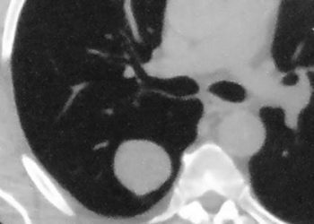 Many lung cancers visible on prior imaging studies