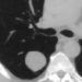 Many lung cancers visible on prior imaging studies