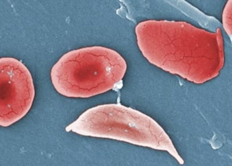 Updated guidelines for management of sickle cell disease released