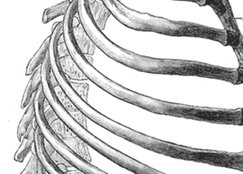 Cryoablation safe and effective for pain control in sternal metastases