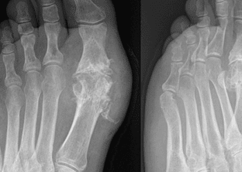 Increased diabetes risk observed in gout patients