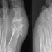 Increased diabetes risk observed in gout patients
