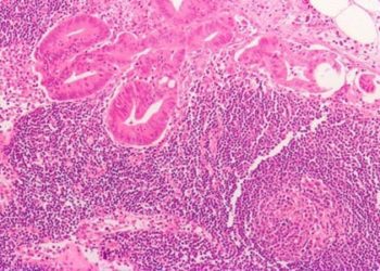 Noninvasive imaging method detects and evaluates size of metastases