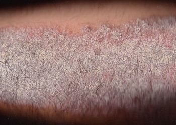 Severe psoriasis linked with poorly controlled blood pressure