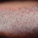 Severe psoriasis linked with poorly controlled blood pressure