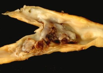 2 Minute Medicine Rewind October 12 – 19, 2014