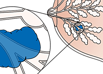 Radiotherapy with breast-conserving surgery proves beneficial