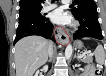 Incidence of esophageal cancer subtypes vary drastically globally and by gender