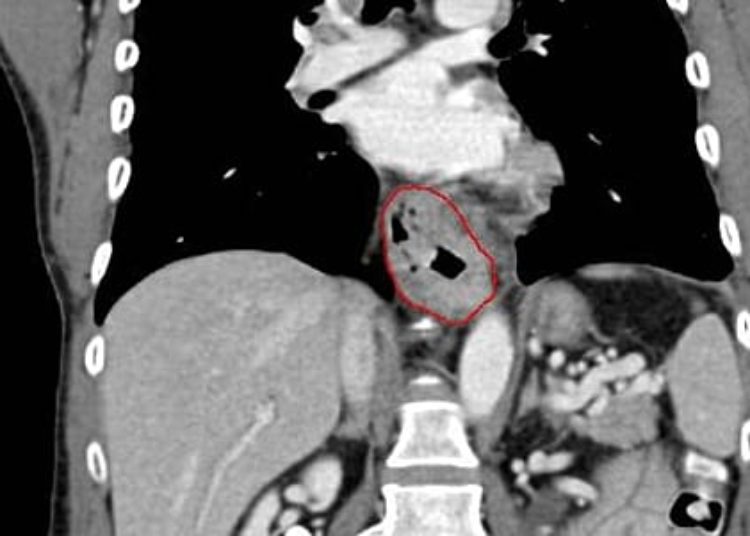 Incidence of esophageal cancer subtypes vary drastically globally and by gender