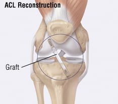 acl3