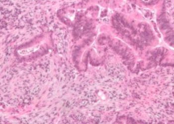 Genetic, environmental risk assessment does not increase colon cancer screening