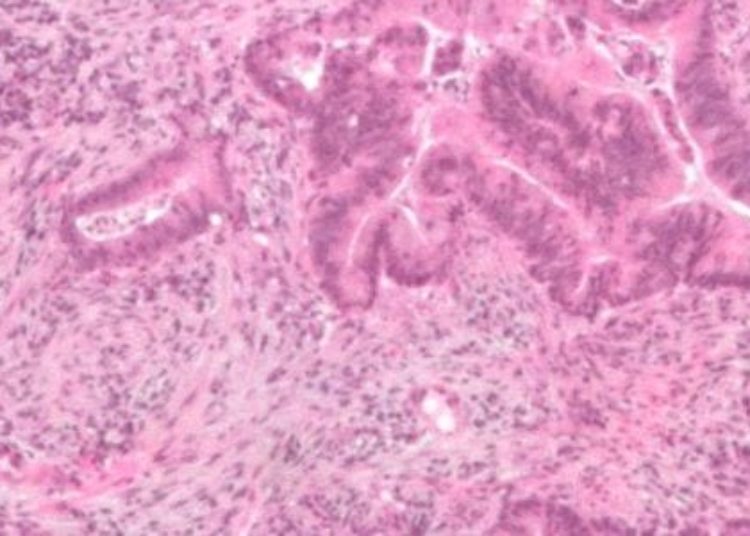 Genetic, environmental risk assessment does not increase colon cancer screening