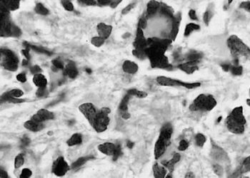 Quantitative MRI may differentiate true from pseudoprogression in glioblastoma