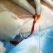 Clinicians frequently unaware of the presence of central venous catheters
