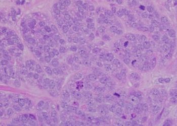 25% reoperation risk after breast-conserving lumpectomy