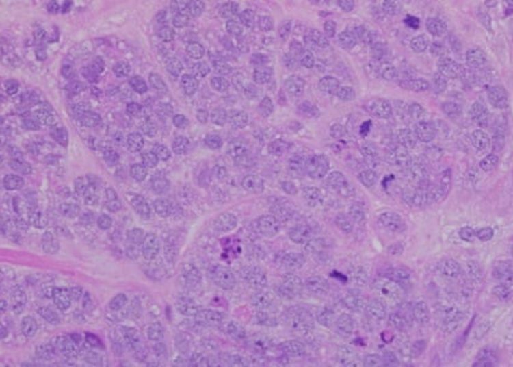 25% reoperation risk after breast-conserving lumpectomy