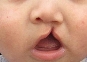 Double-opposing Z-plasty may improve cleft palate outcomes
