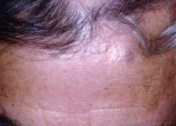 Patient Basics: Alopecia Areata