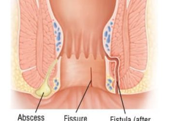 Patient Basics: Anal Disorders