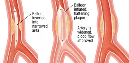 the proper treatment for blocked or narrowed coronary arteries Why do arteries become narrow blocked arteries are blocked many people with blocked arteries or atherosclerosis are at their coronary arteries. the proper treatment for blocked or narrowed coronary arteries Why do arteries become narrow blocked arteries are blocked many people with blocked arteries or atherosclerosis are at their coronary arteries.