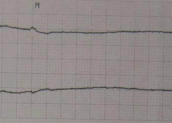 Mechanical CPR provides no benefit over manual CPR [PARAMEDIC trial]