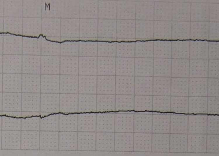 Mechanical CPR provides no benefit over manual CPR [PARAMEDIC trial]