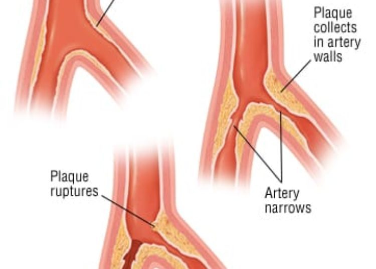 Patient Basics: Atherosclerosis