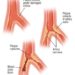 Patient Basics: Atherosclerosis