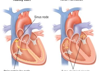 Patient Basics: Atrial Fibrillation