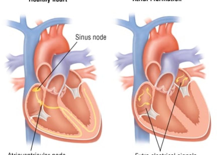 Patient Basics: Atrial Fibrillation