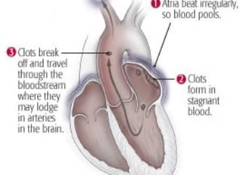 Patient Basics: Atrial Fibrillation